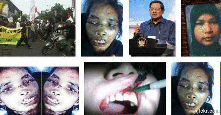 photo gambar penyiksaan TKI / TKW sumiati di Saudi